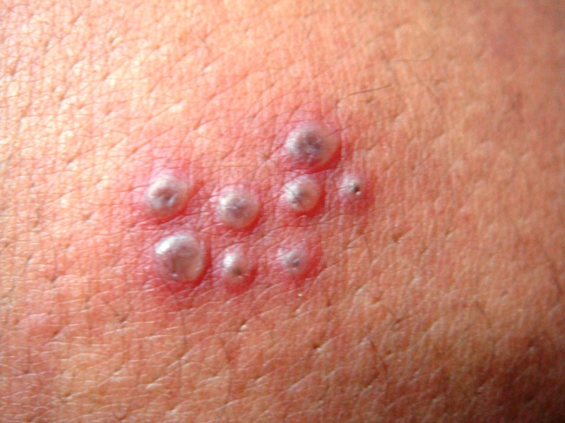 Pictures of the shingles rash and virus - Slideshow
